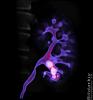 CT 3D njure av Torbjrn Ahl